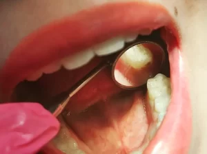 دندان هایی زیبا و سفید
